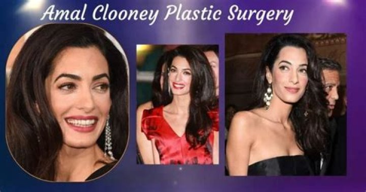 Amal Clooney Plastic Surgery: The Probability of Getting Botox Injections and Dermal Fillers!