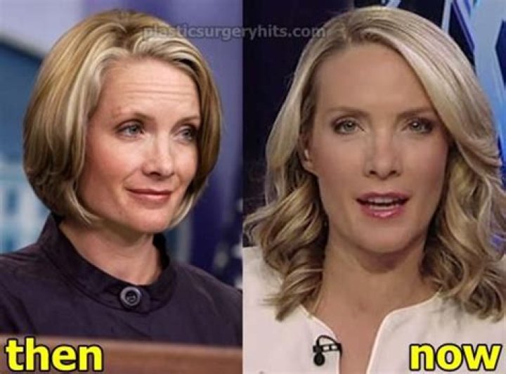Dana Perino Plastic Surgery: Aging Gracefully or Nipped and Tucked?