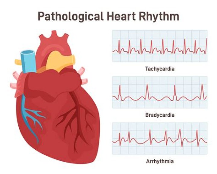 Did Ray Liotta have cancer? Arrhythmic death syndrome explained