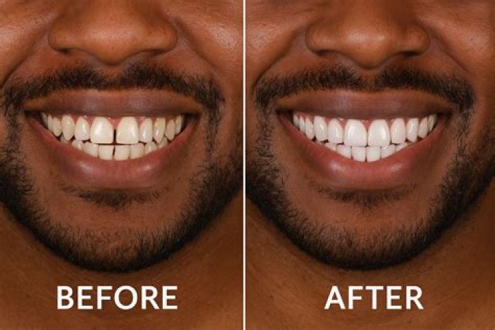 Harrison Bader Teeth Before And After: Did He Repaired?