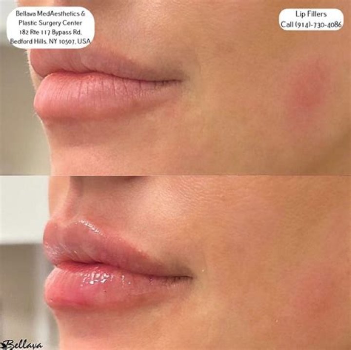 
Has Carol Vorderman Done Botox? Fans Suspect Lip Filler And Nose Job 