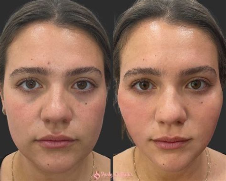 Has Tara Lipinski Gotten Plastic Surgery? Before and After Photos Revealed On Instagram
