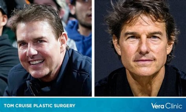 Has Tom Cruise ever had plastic surgery?