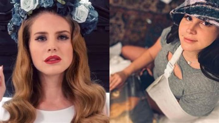 Is Lana Del Rey’s broken arm real?