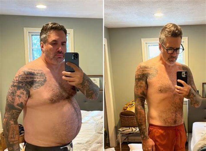 
James Nesbitt Weight Loss Journey: Does He Wear A Wig? Hair Transplant And Surgery Update 
