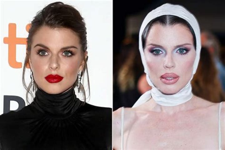 Julia Tica plastic surgery before and after photo