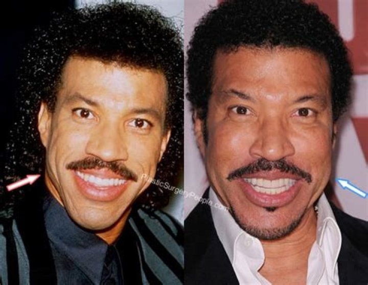 Lionel Richie Plastic Surgery: The Truth Behind the Plastic Surgery Speculations
