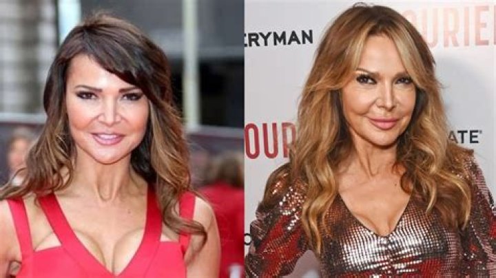 Lizzie Cundy Plastic Surgery: A Closer Look at Her Plastic Surgery Journey