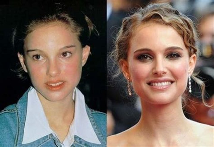 Natalie Portman Plastic Surgery Before and After