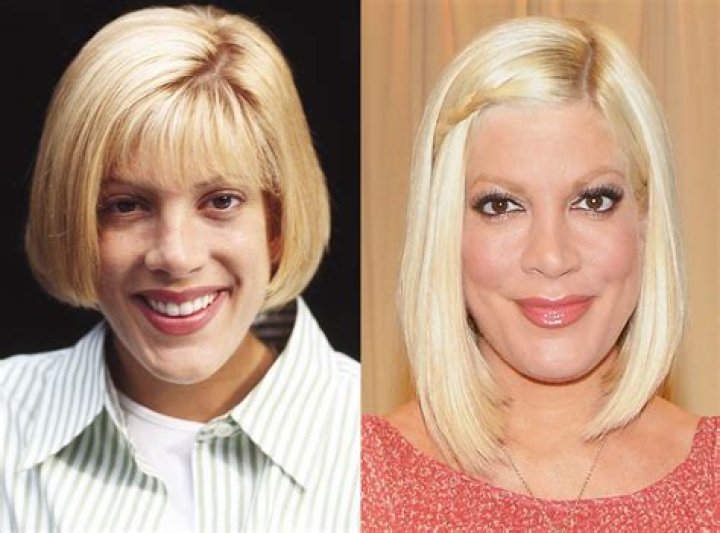 Tori Spelling Plastic Surgery Before and After