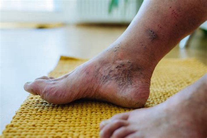 What Happened To Onlyusemeblade Teeth? Legs Sore & Foot